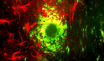 Star–like glial cells in red surround alpha beta plagues in the cortex of a mouse with a model of Alzheimer’s disease.
