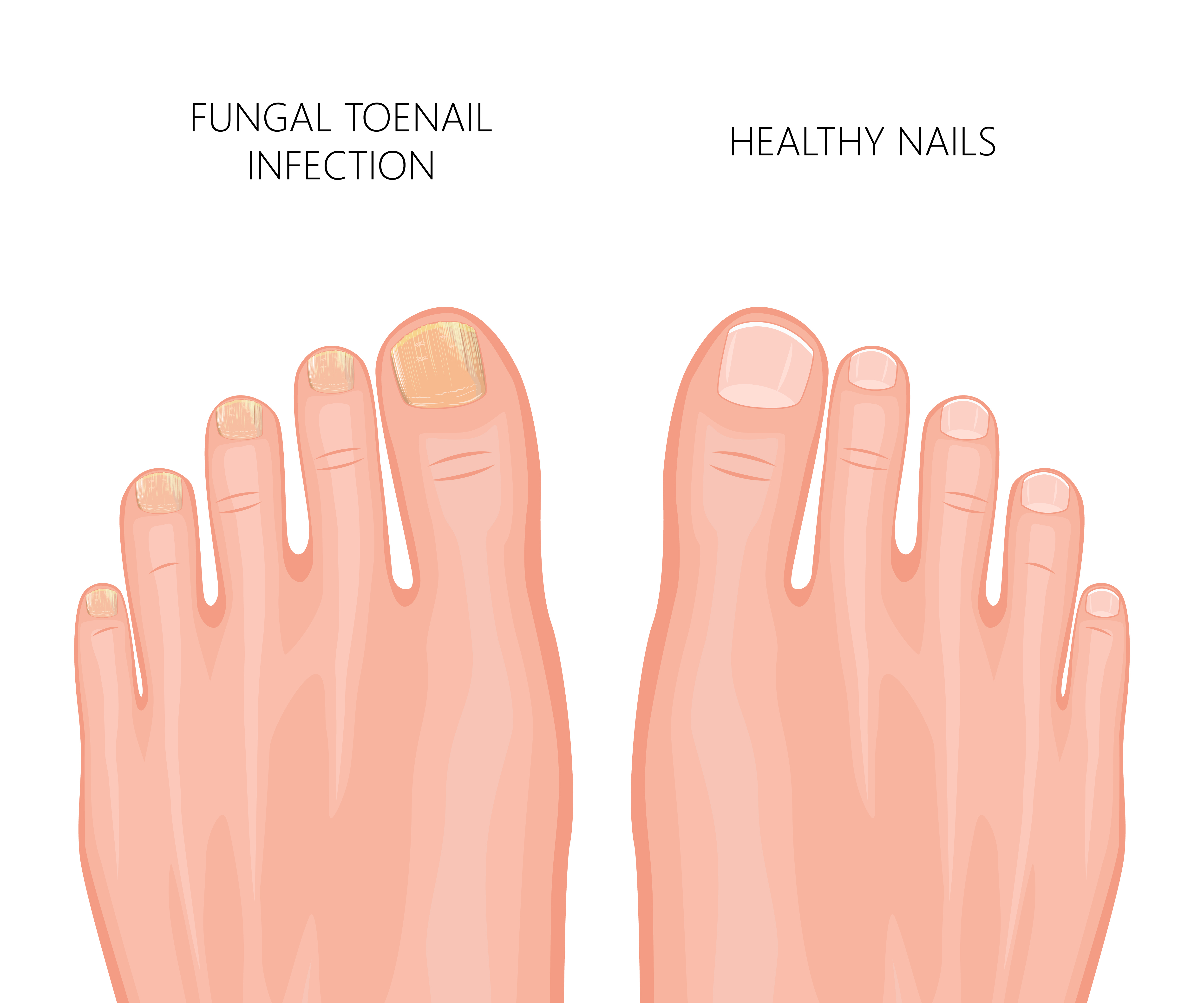 How does laser treatment fix fungal nail infection? | Waverley Foot Clinic